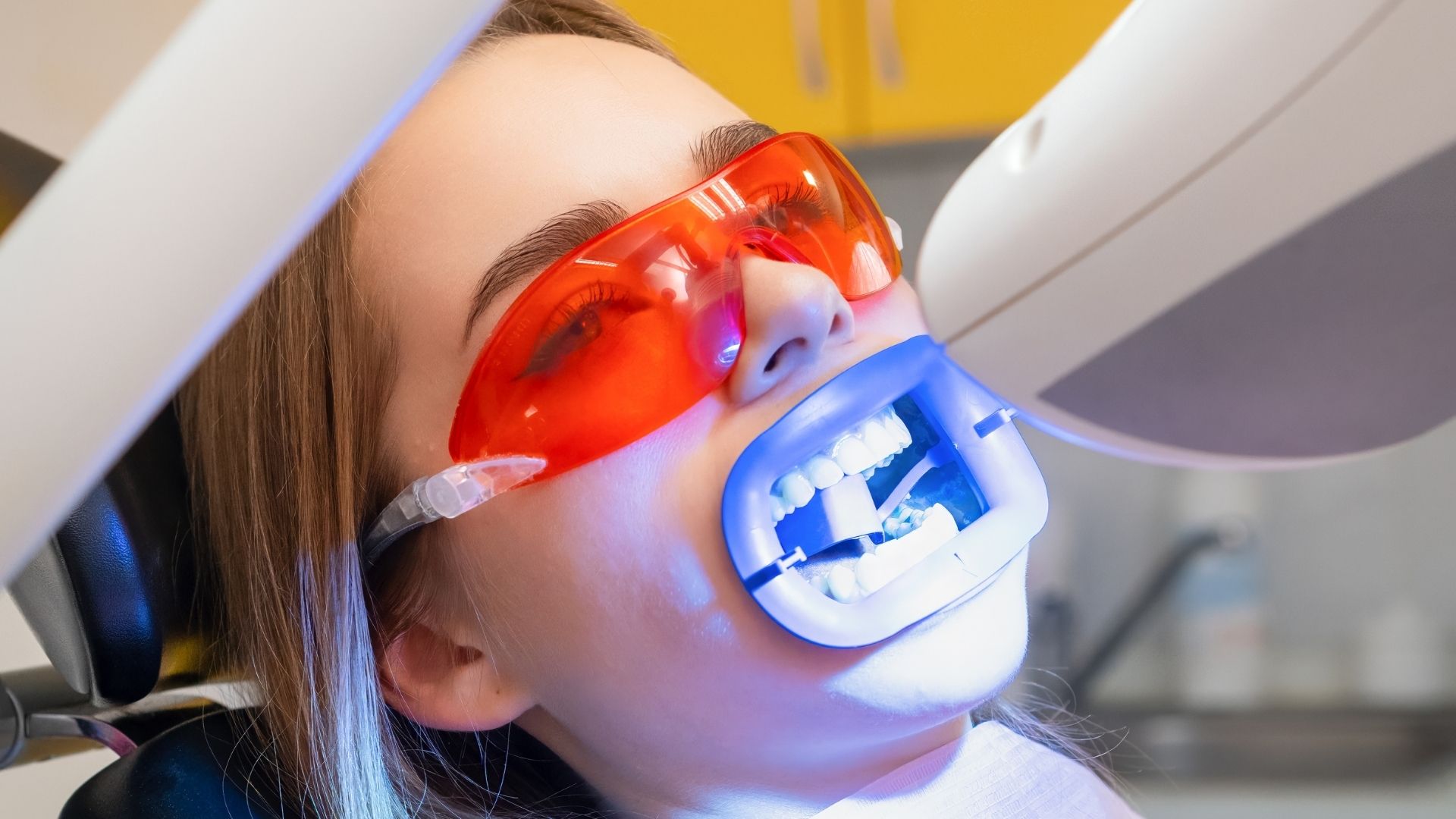 Teeth Bleaching in Udaipur