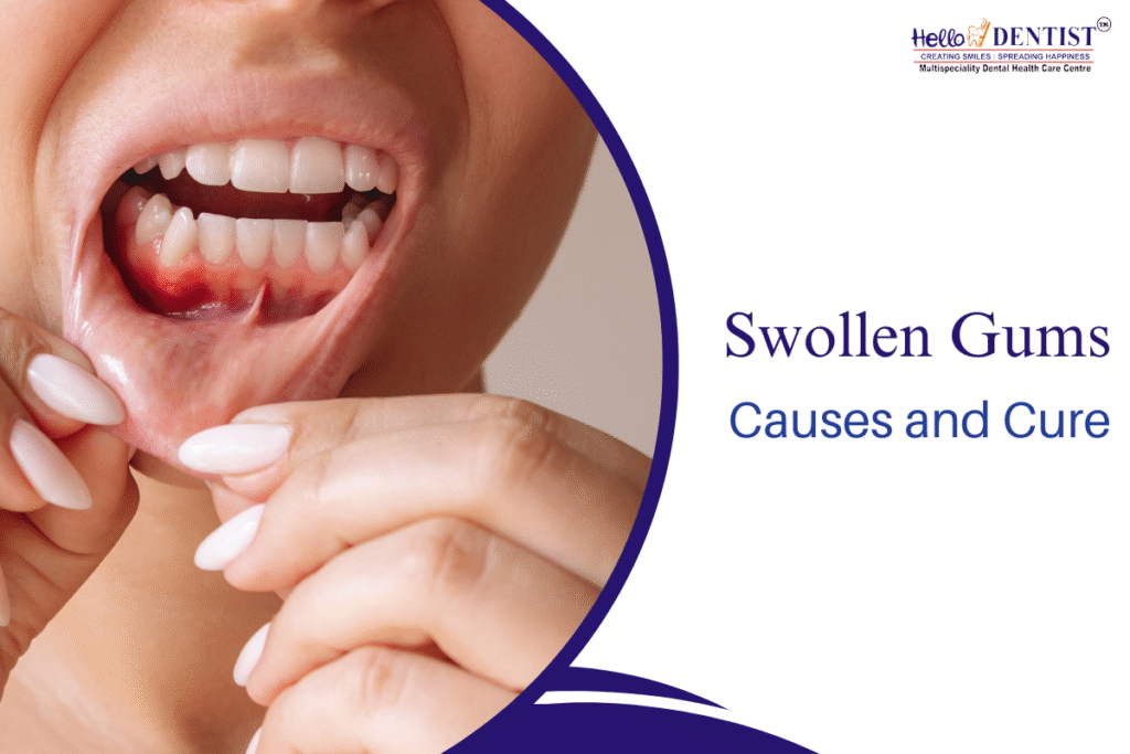 Swollen Gums Treatment