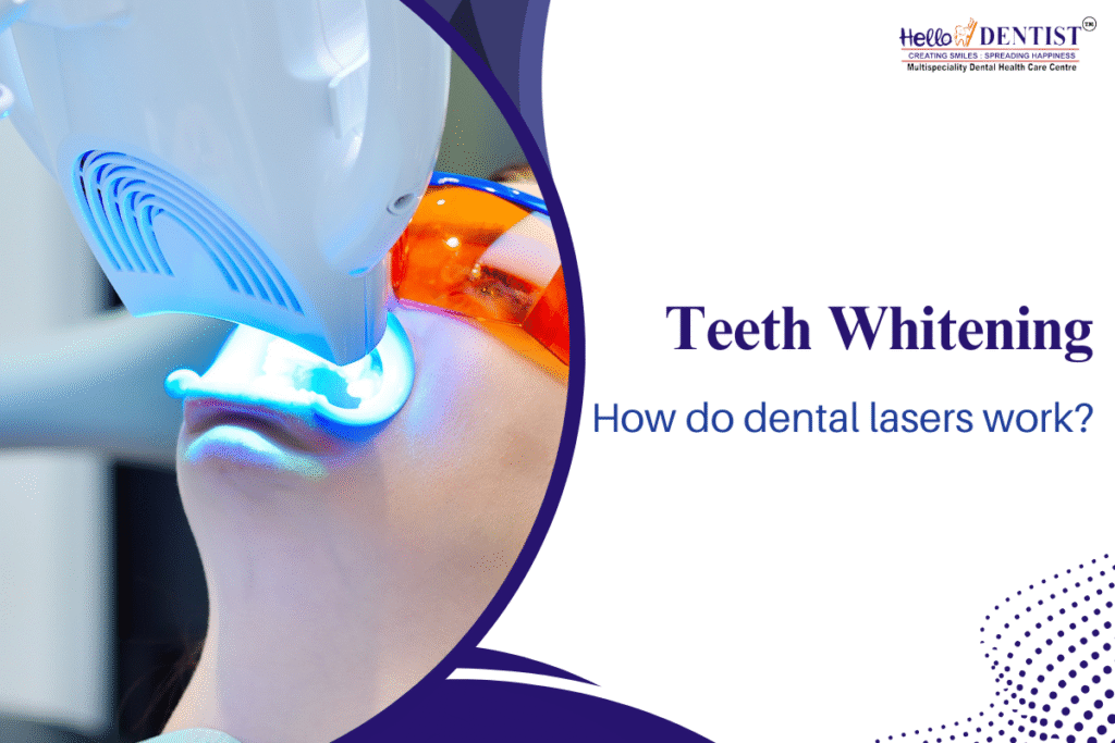 Why Laser Teeth Whitening